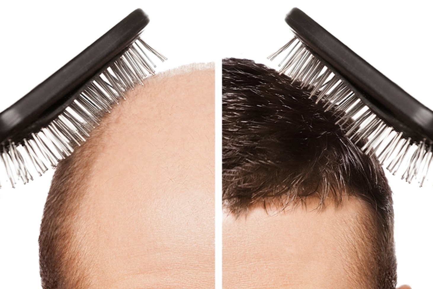 Ankara’da uygulanan protez saç sonuçları