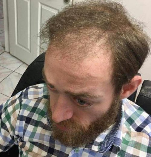 Protez Saç
