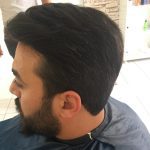 Protez Saç